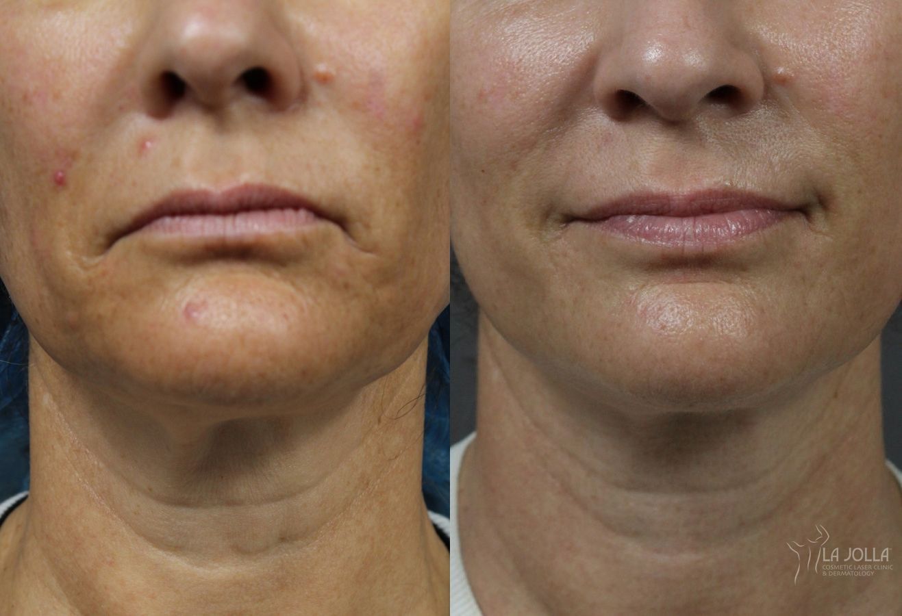 Before and after Laser Coring (Poke A Dot Lift®) case 36404