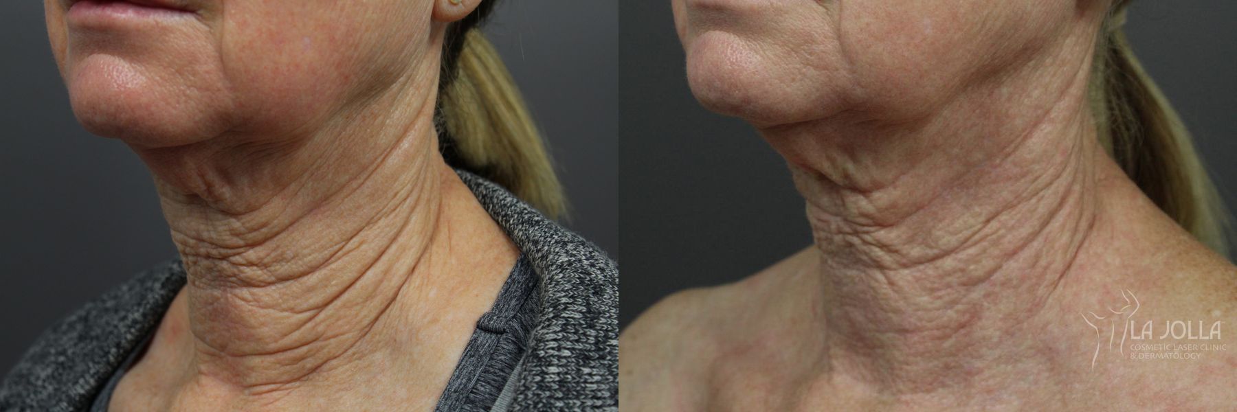 Before and after Laser Coring (Poke A Dot Lift®) case 36396