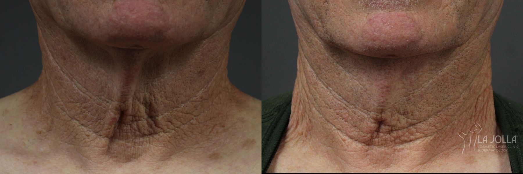 Before and after Laser Coring (Poke A Dot Lift®) case 36091