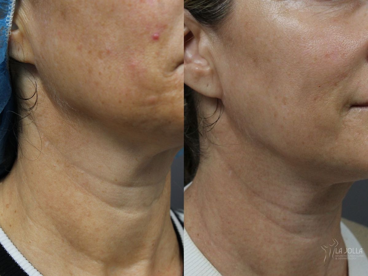 Before and after Laser Coring (Poke A Dot Lift®) case 36404 - Angle 3
