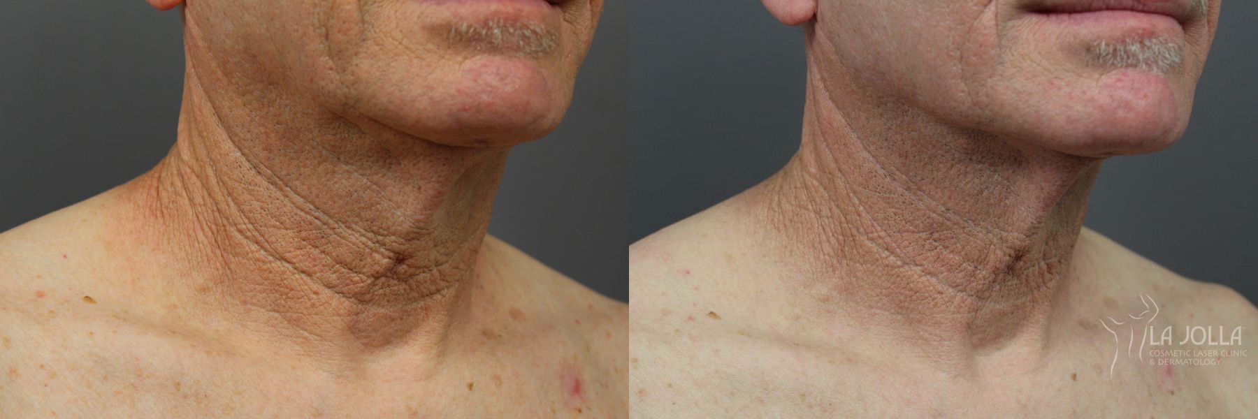 Before and after Laser Coring (Poke A Dot Lift®) case 36386