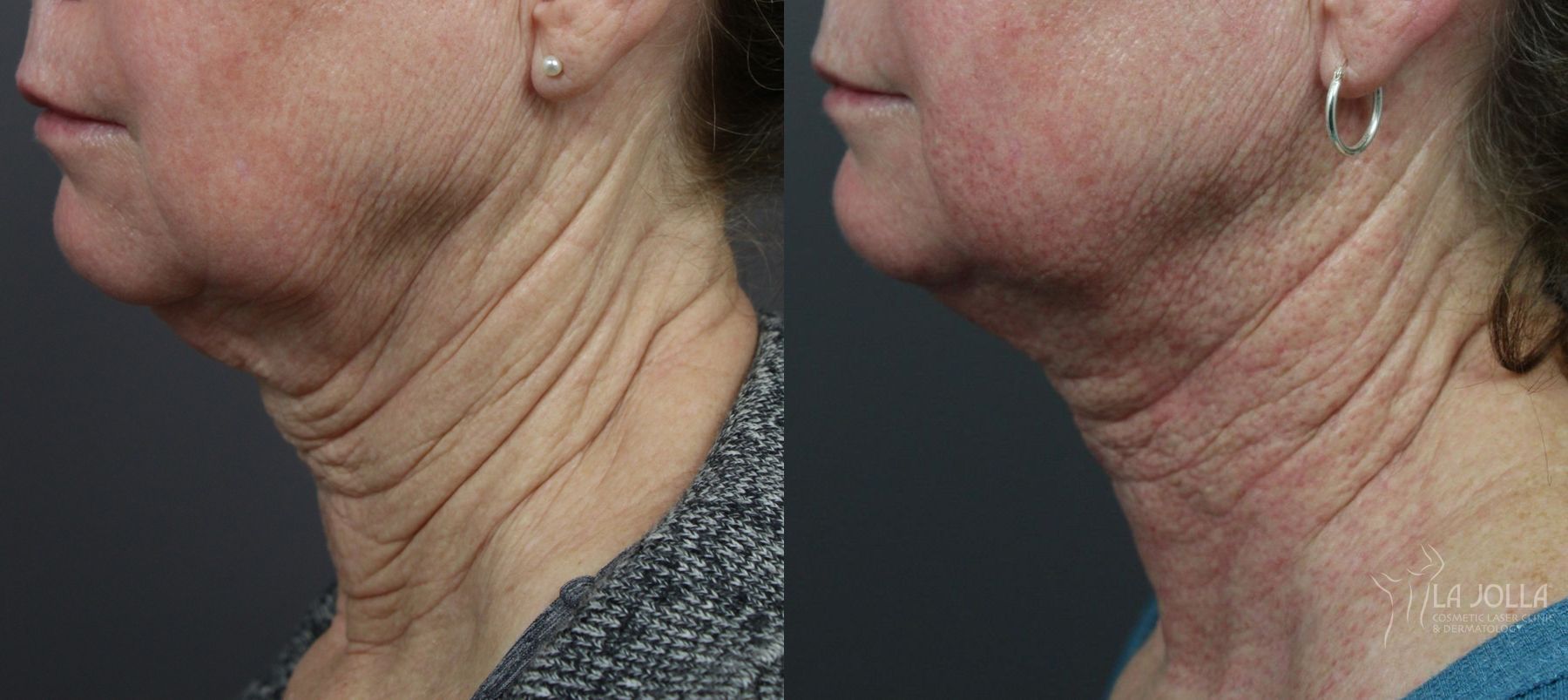 Before and after Laser Coring (Poke A Dot Lift®) case 36157