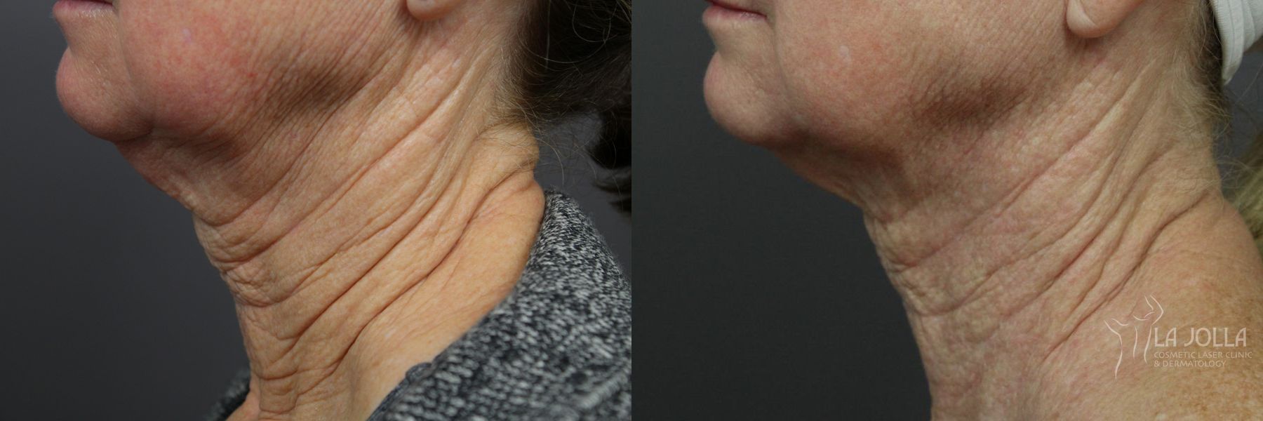 Before and after Laser Coring (Poke A Dot Lift®) case 36396 - Angle 2