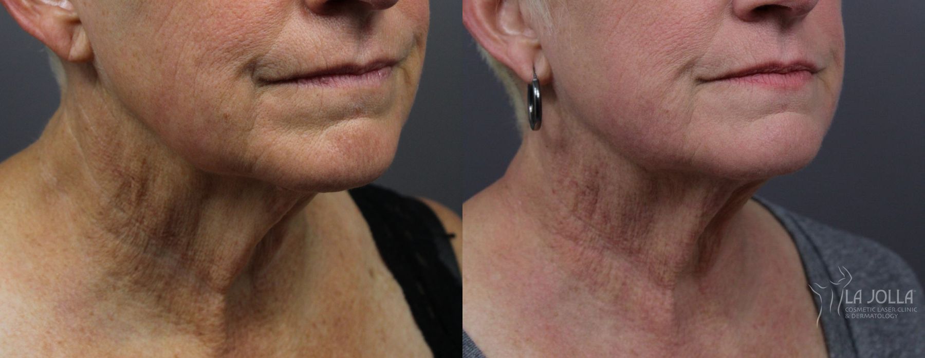 Before and after Laser Coring (Poke A Dot Lift®) case 36177