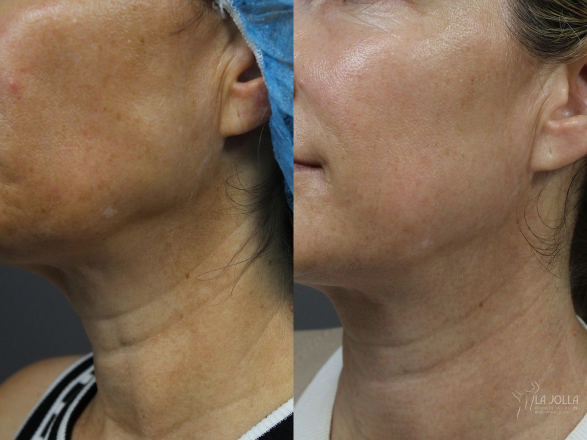 Before and after Laser Coring (Poke A Dot Lift®) case 36404 - Angle 2