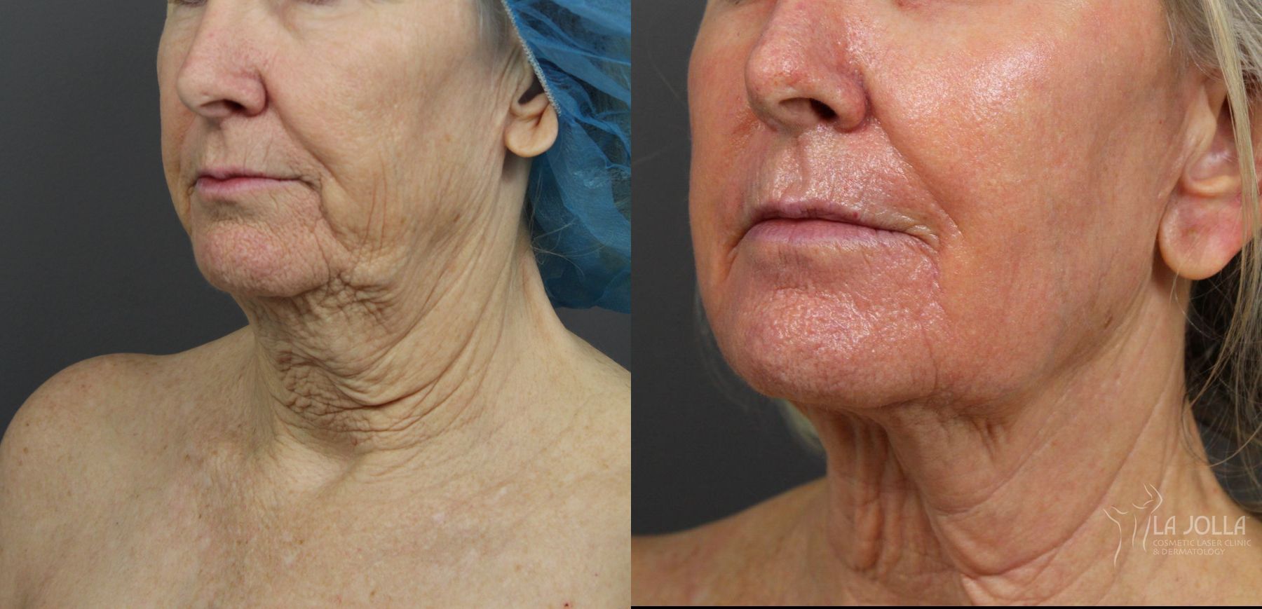 Before and after Laser Coring (Poke A Dot Lift®) case 36123 - Angle 2