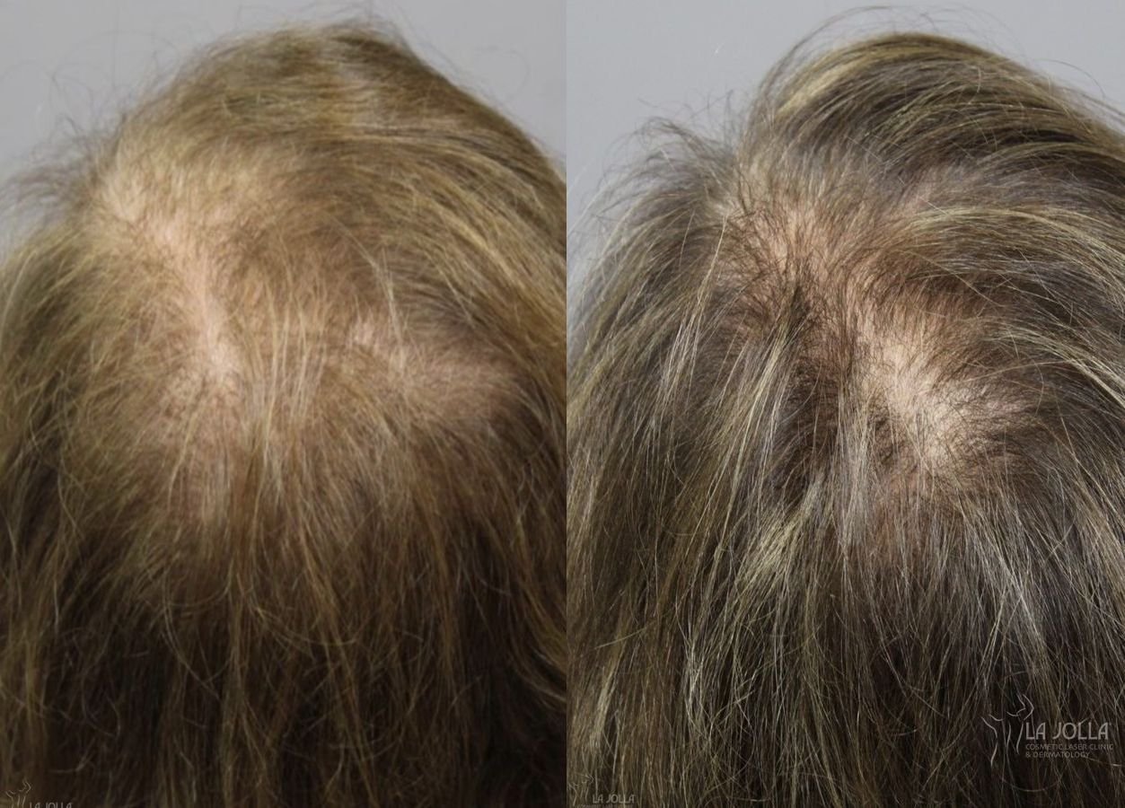 Before and after Laser Hair Growth case 36208