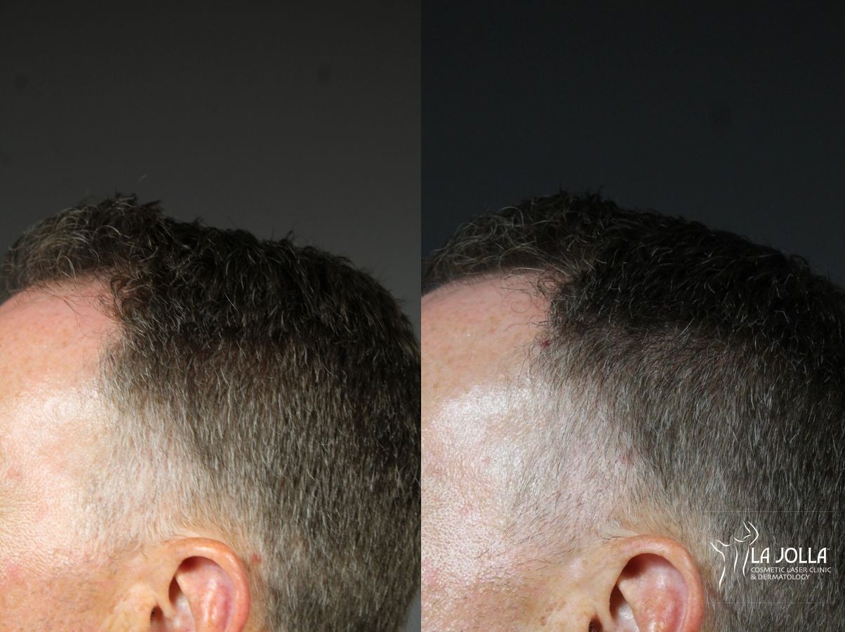 Before and after Laser Hair Growth case 36144 - Angle 4