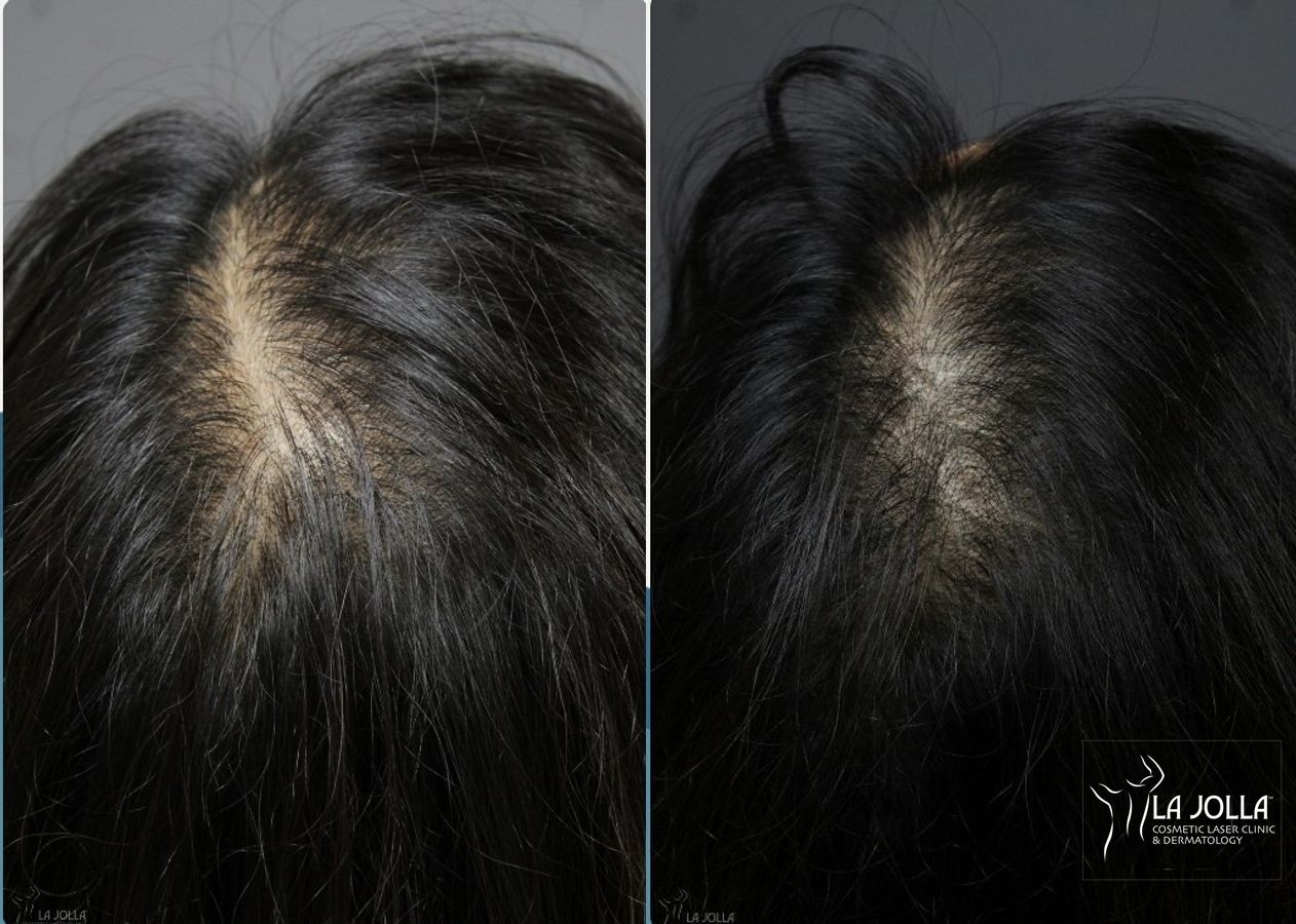 Before and after Laser Hair Growth case 36074