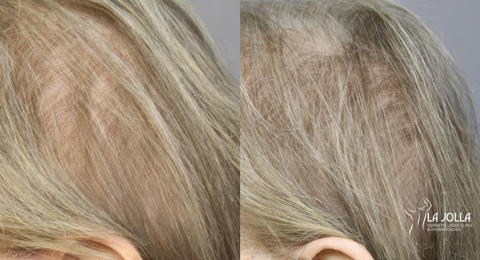 Before and after Laser Hair Growth case 36155 - Angle 3