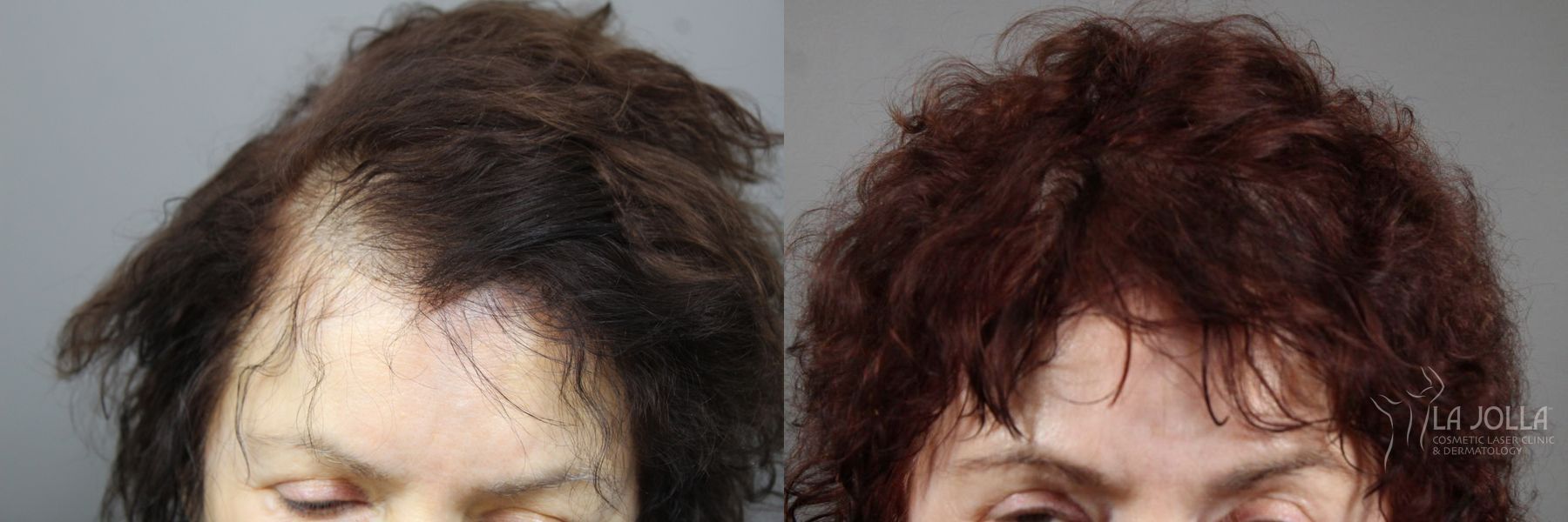 Before and after Laser Hair Growth case 36158 - Angle 2