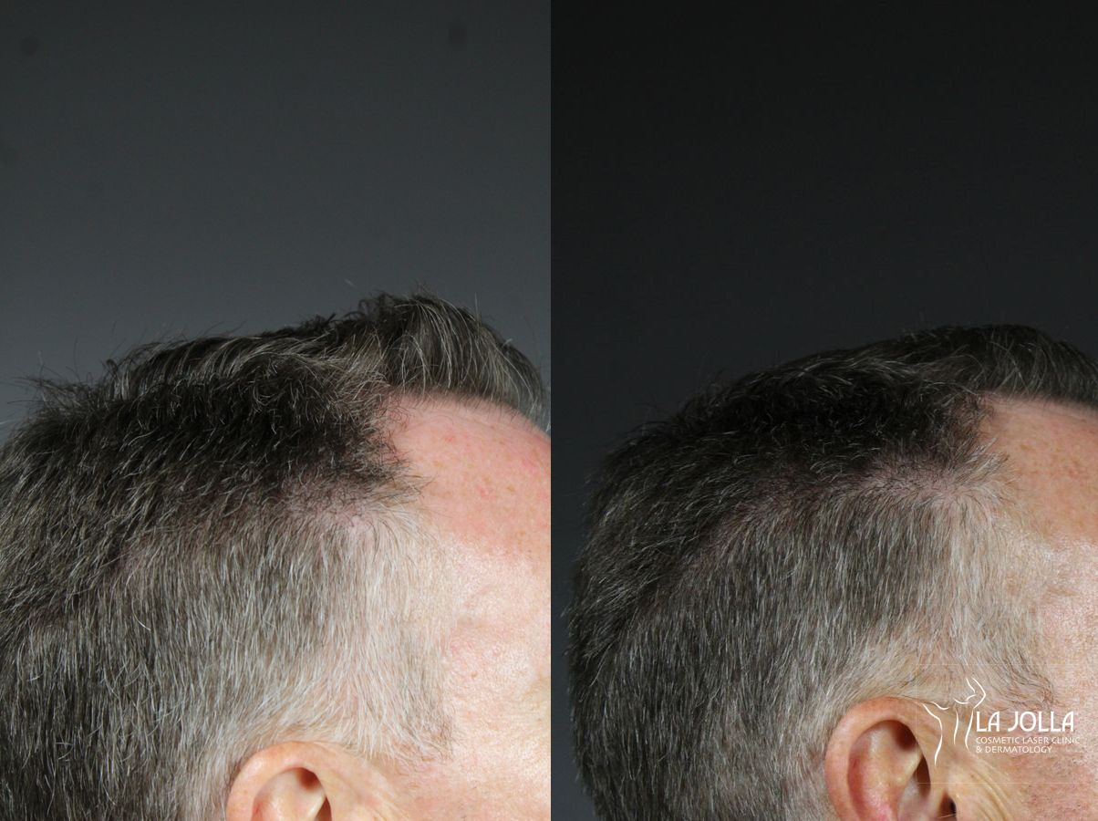 Before and after Laser Hair Growth case 36144 - Angle 3