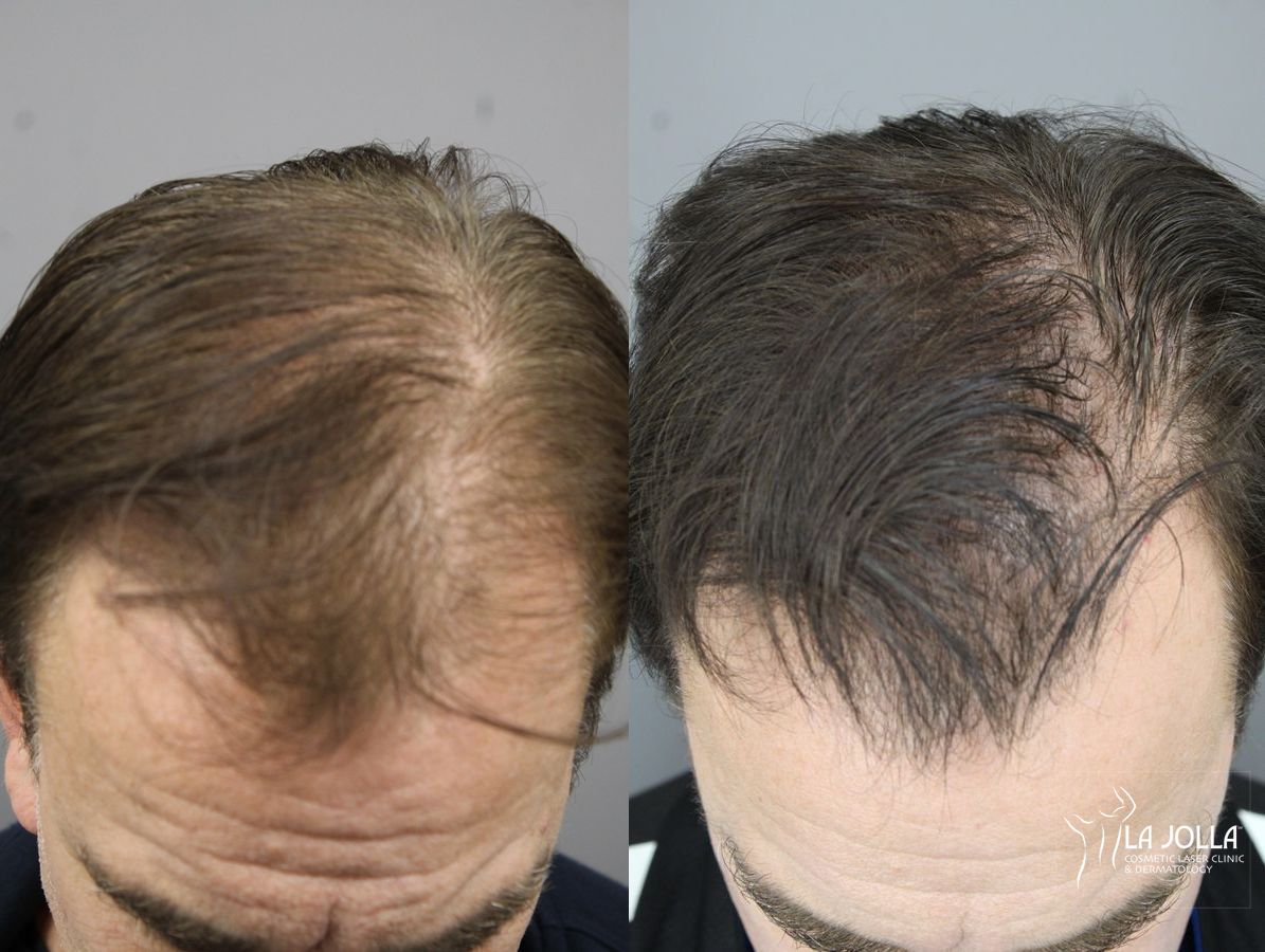 Before and after Laser Hair Growth case 36172 - Angle 2
