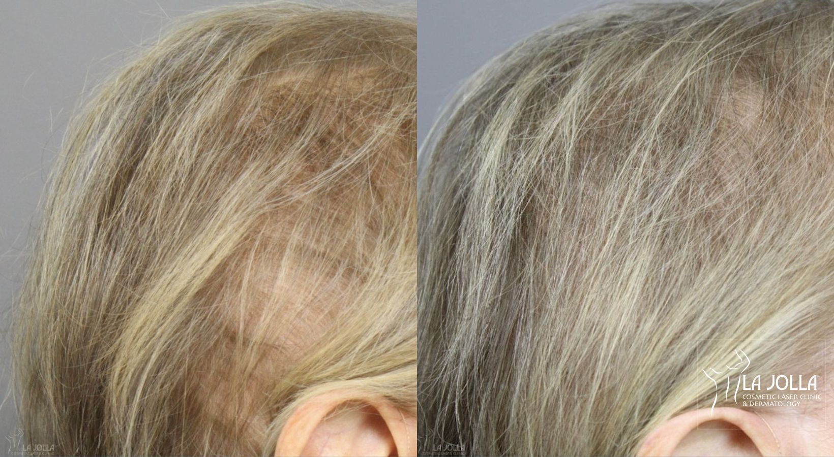 Before and after Laser Hair Growth case 36155 - Angle 2
