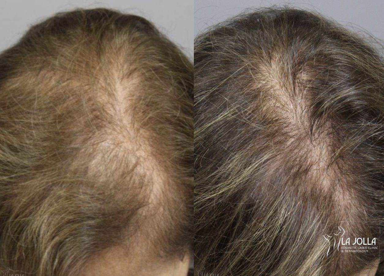 Before and after Laser Hair Growth case 36208 - Angle 2