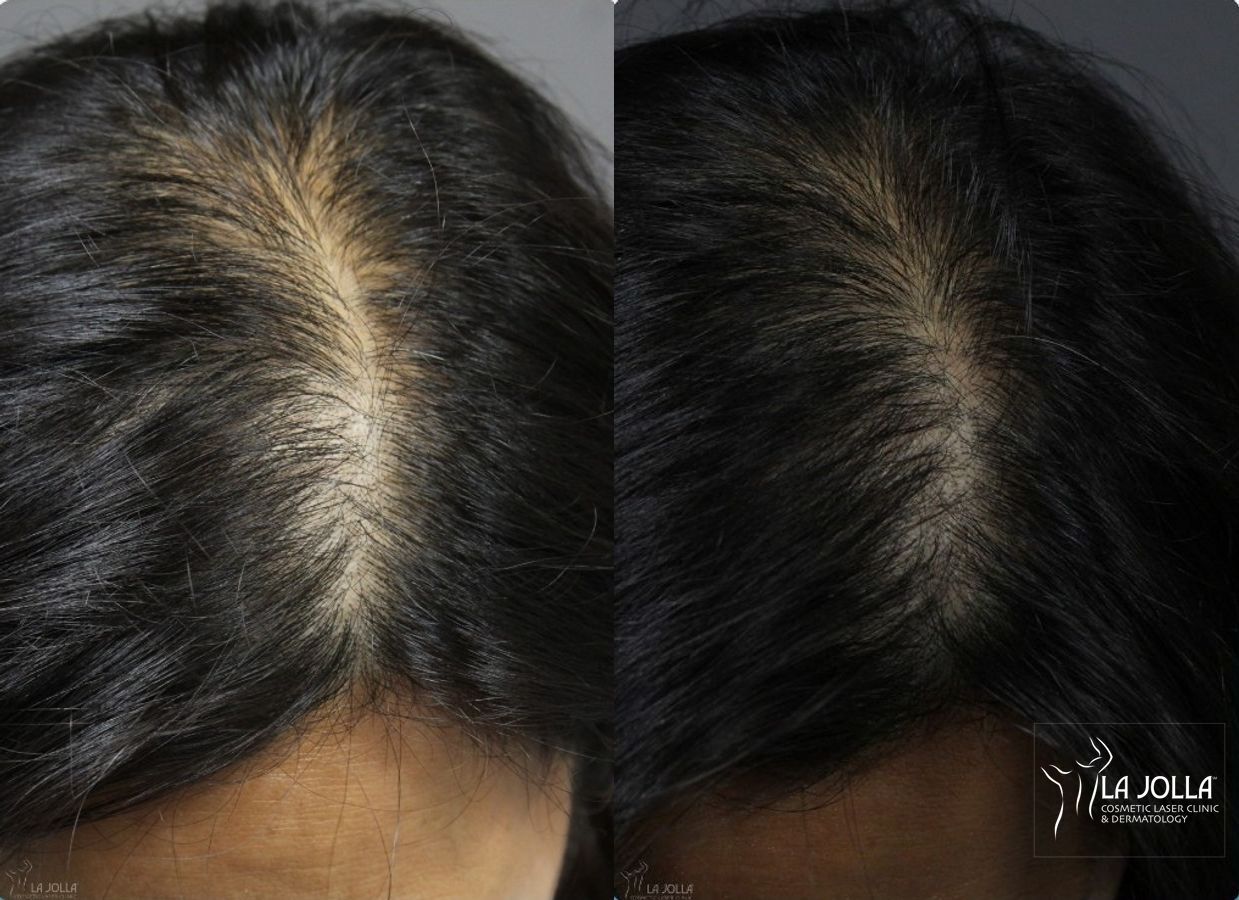 Before and after Laser Hair Growth case 36074 - Angle 2