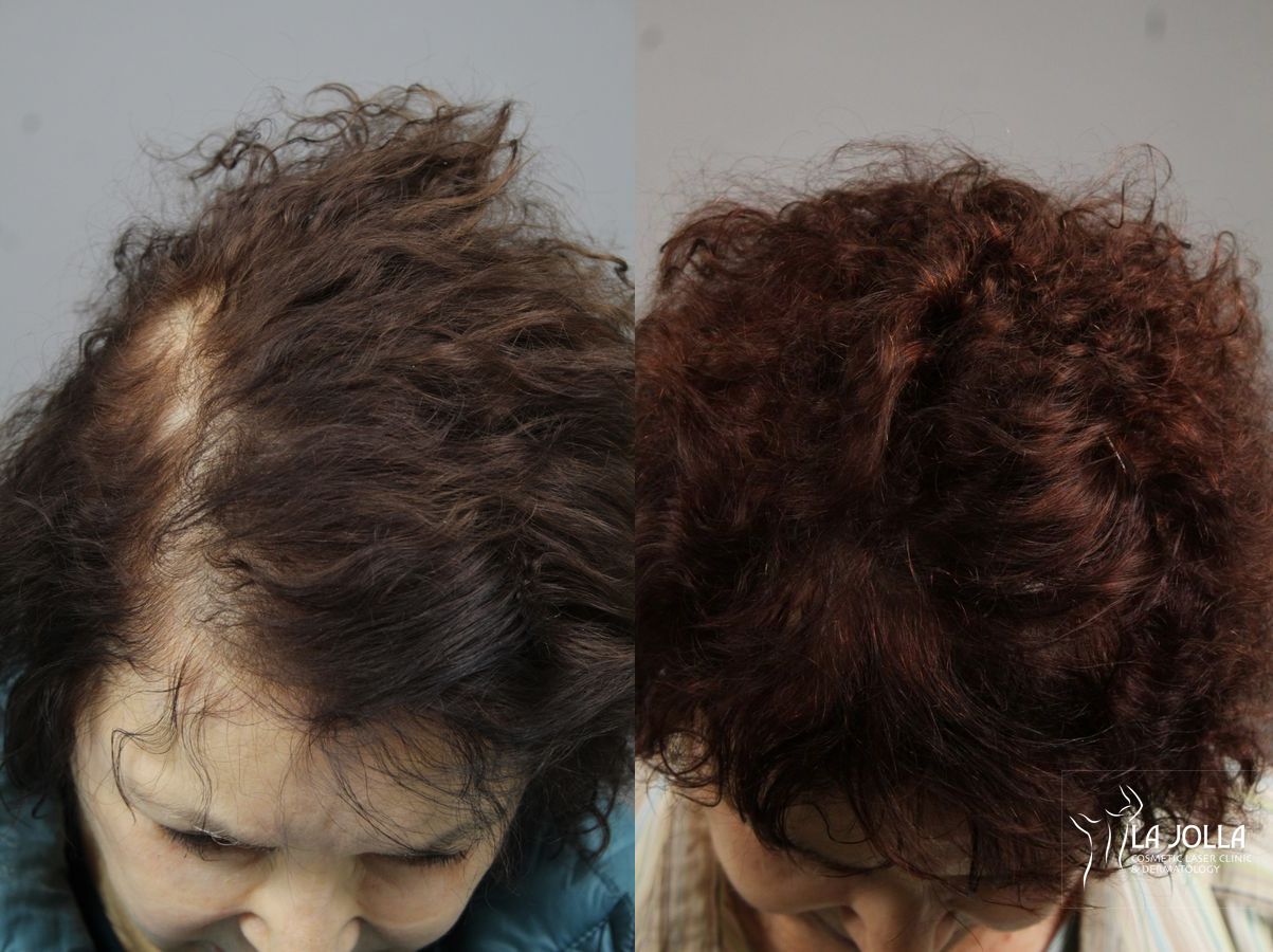 Before and after Laser Hair Growth case 36158