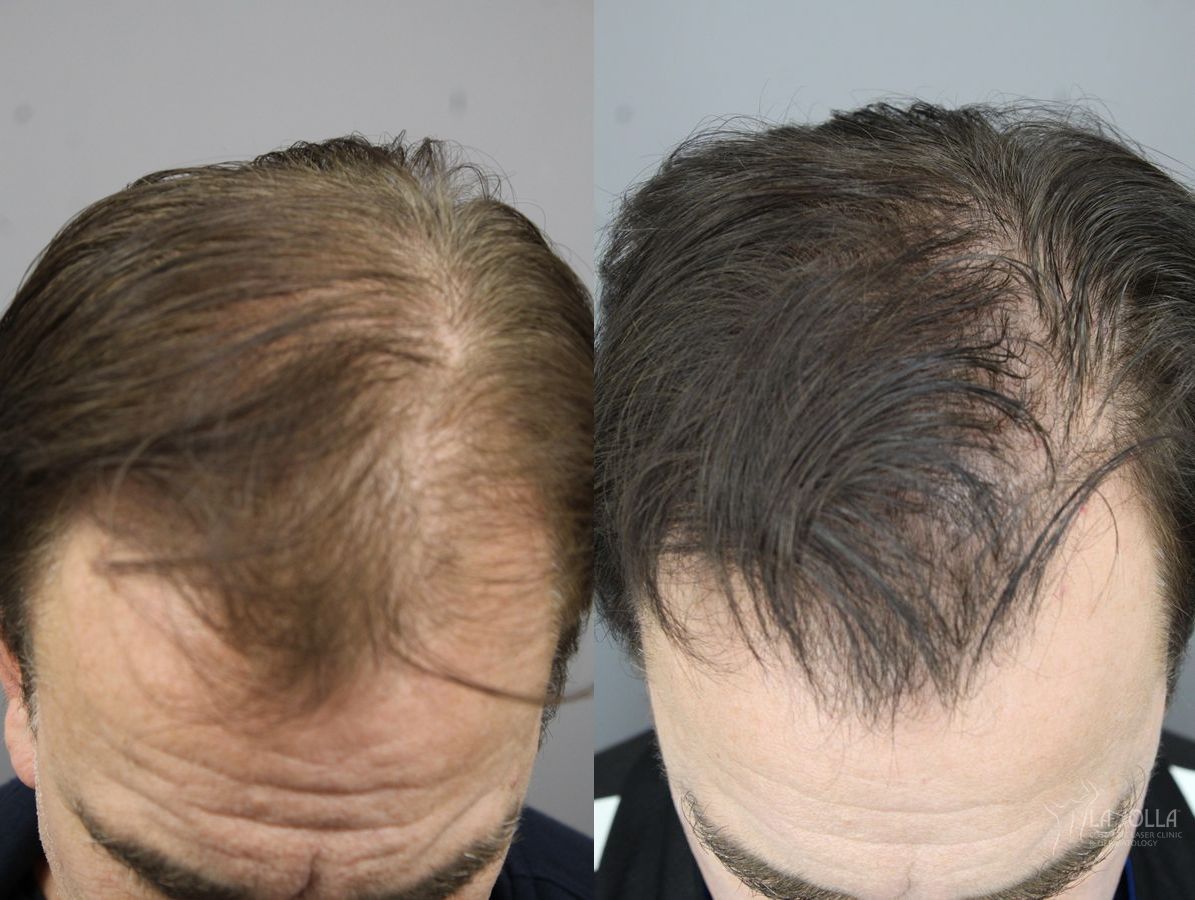 Before and after Laser Hair Growth case 36172 - Angle 2