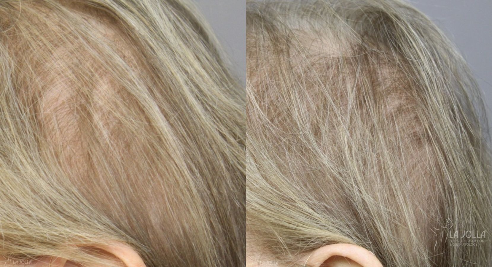 Before and after Laser Hair Growth case 36155 - Angle 3