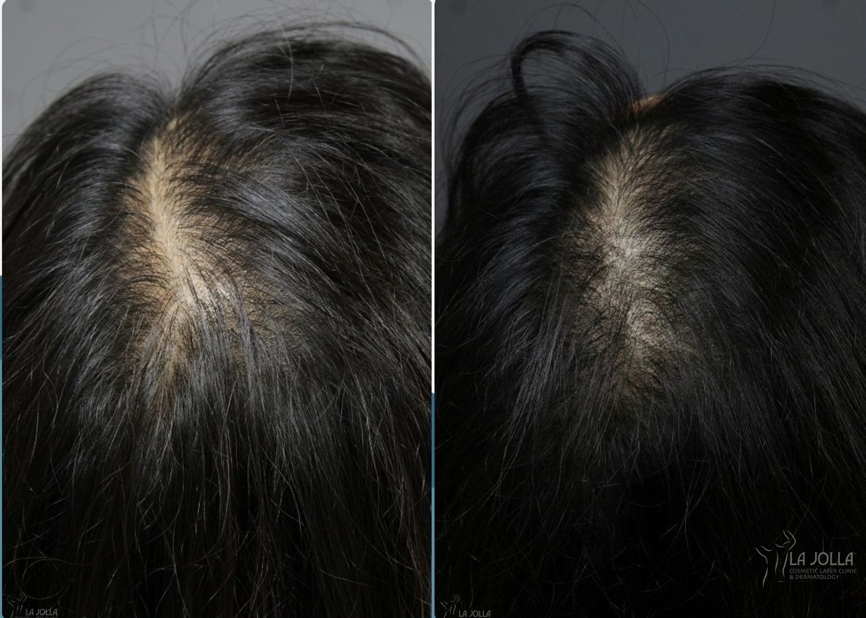 Before and after Laser Hair Growth case 36074