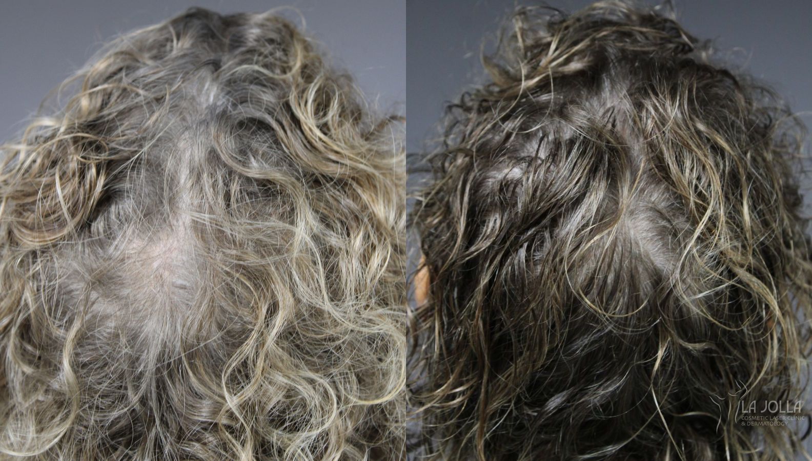 Before and after Laser Hair Growth case 36113 - Angle 2