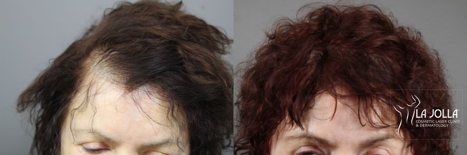 Before and after Laser Hair Growth case 36158 - Angle 2