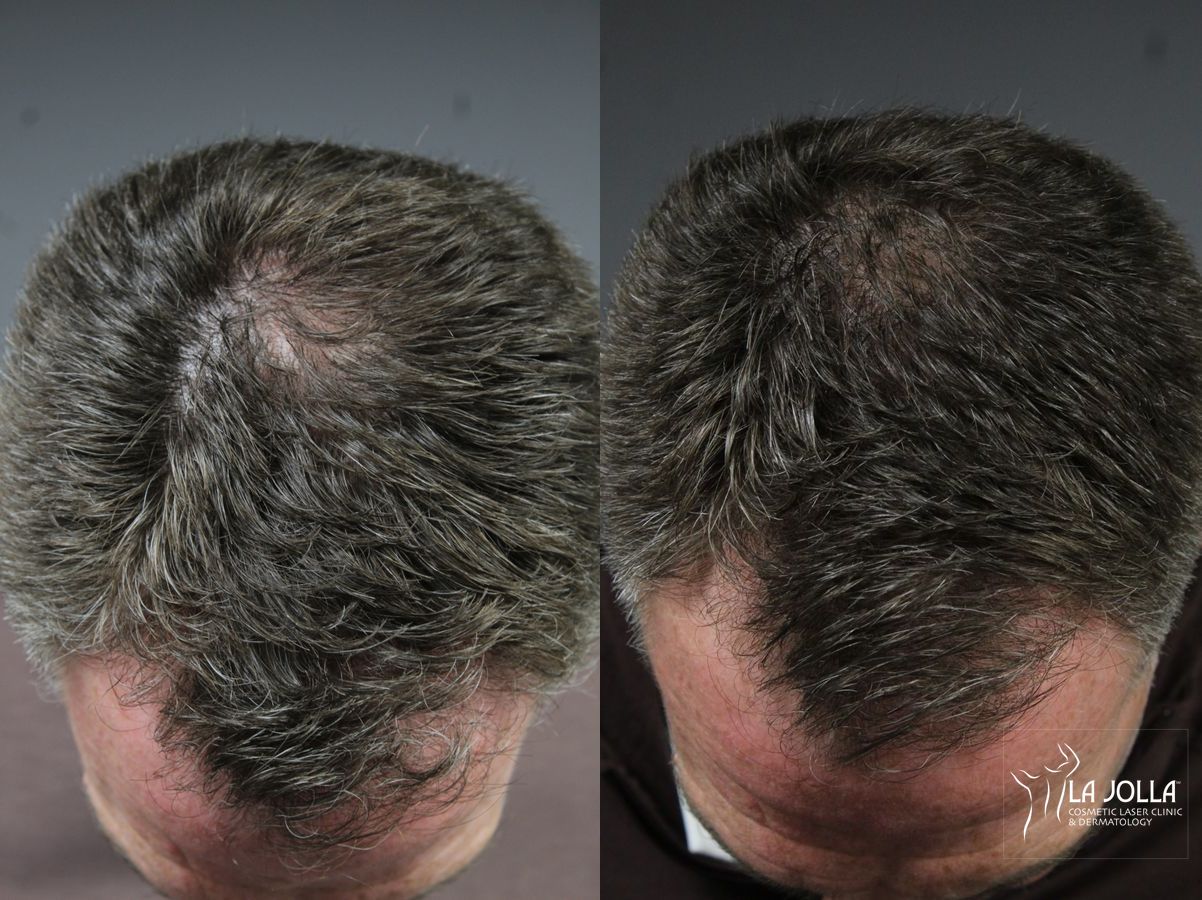 Before and after Laser Hair Growth case 36144 - Angle 2