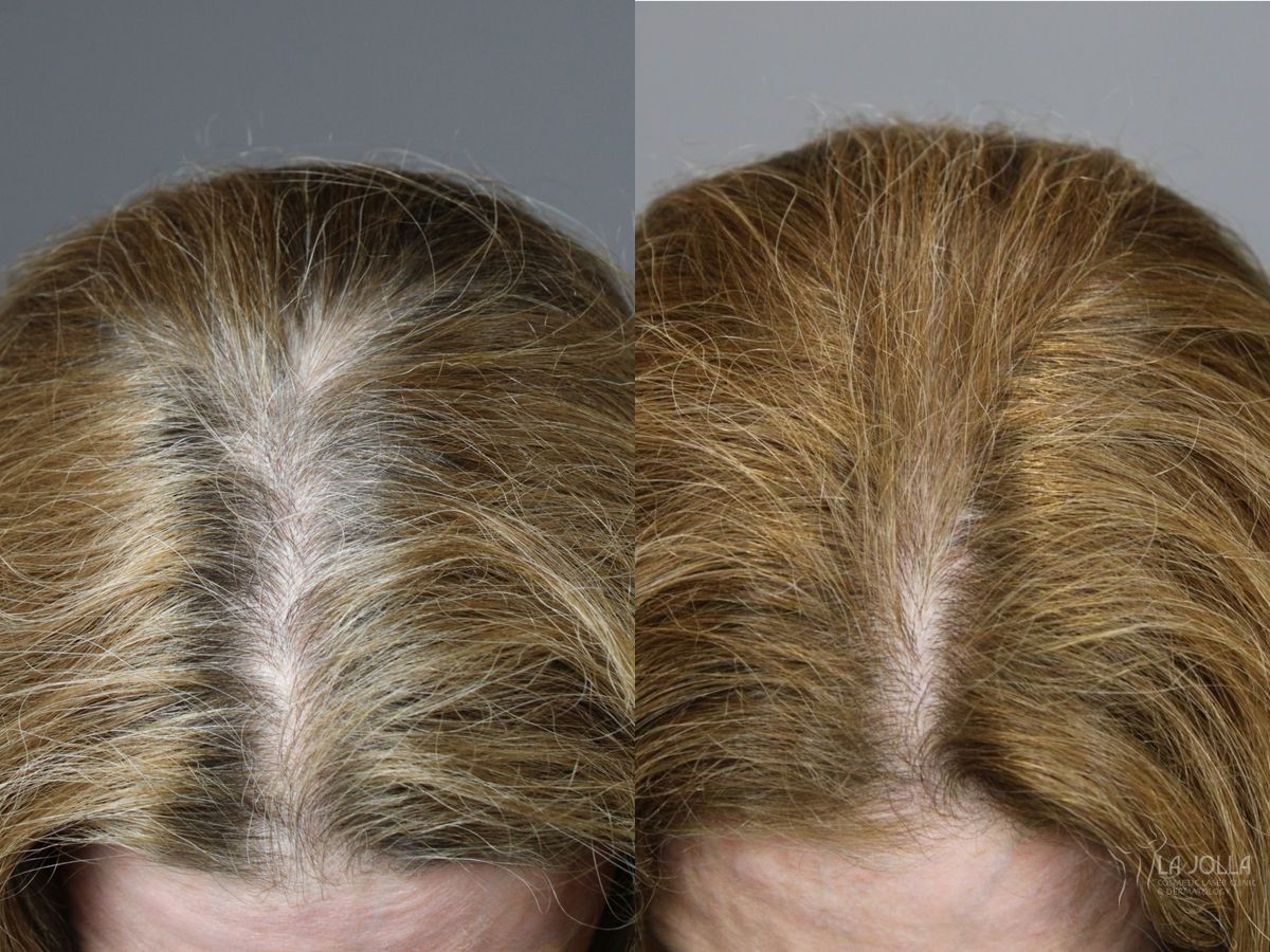 Before and after Laser Hair Growth case 46321