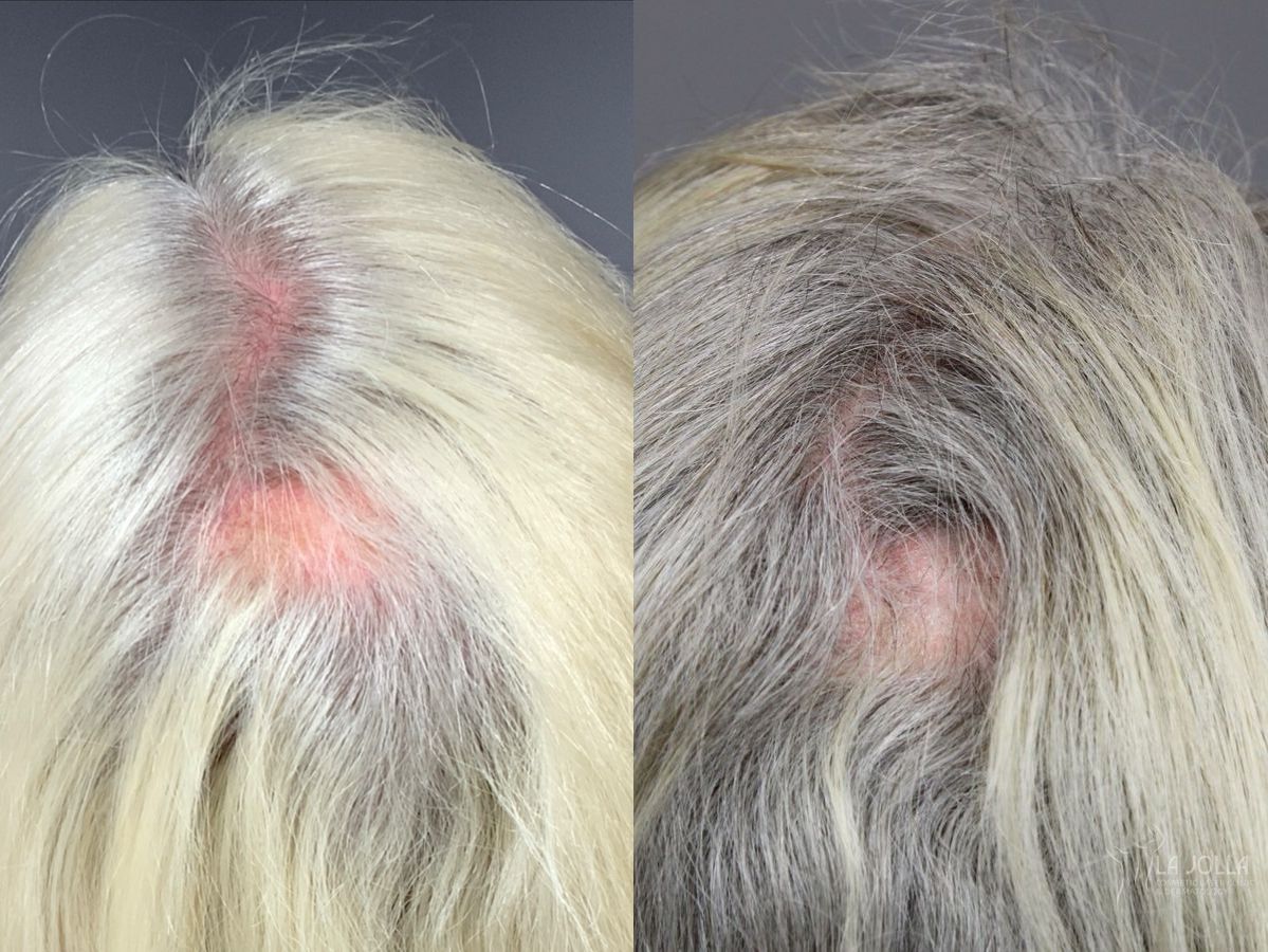 Before and after PRP (Platelet-Rich Plasma) case 49531
