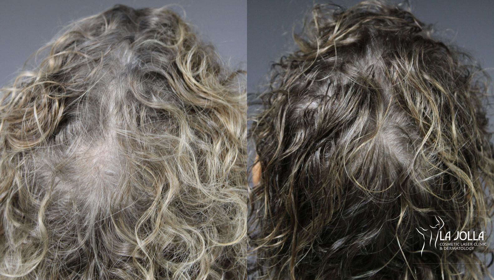 Before and after Laser Hair Growth case 36113 - Angle 2