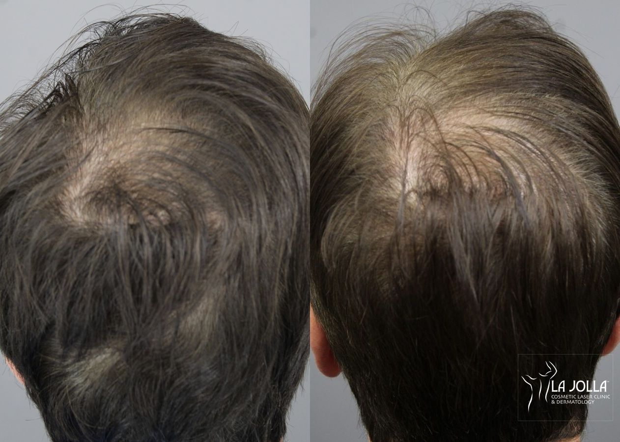 Before and after Laser Hair Growth case 36172