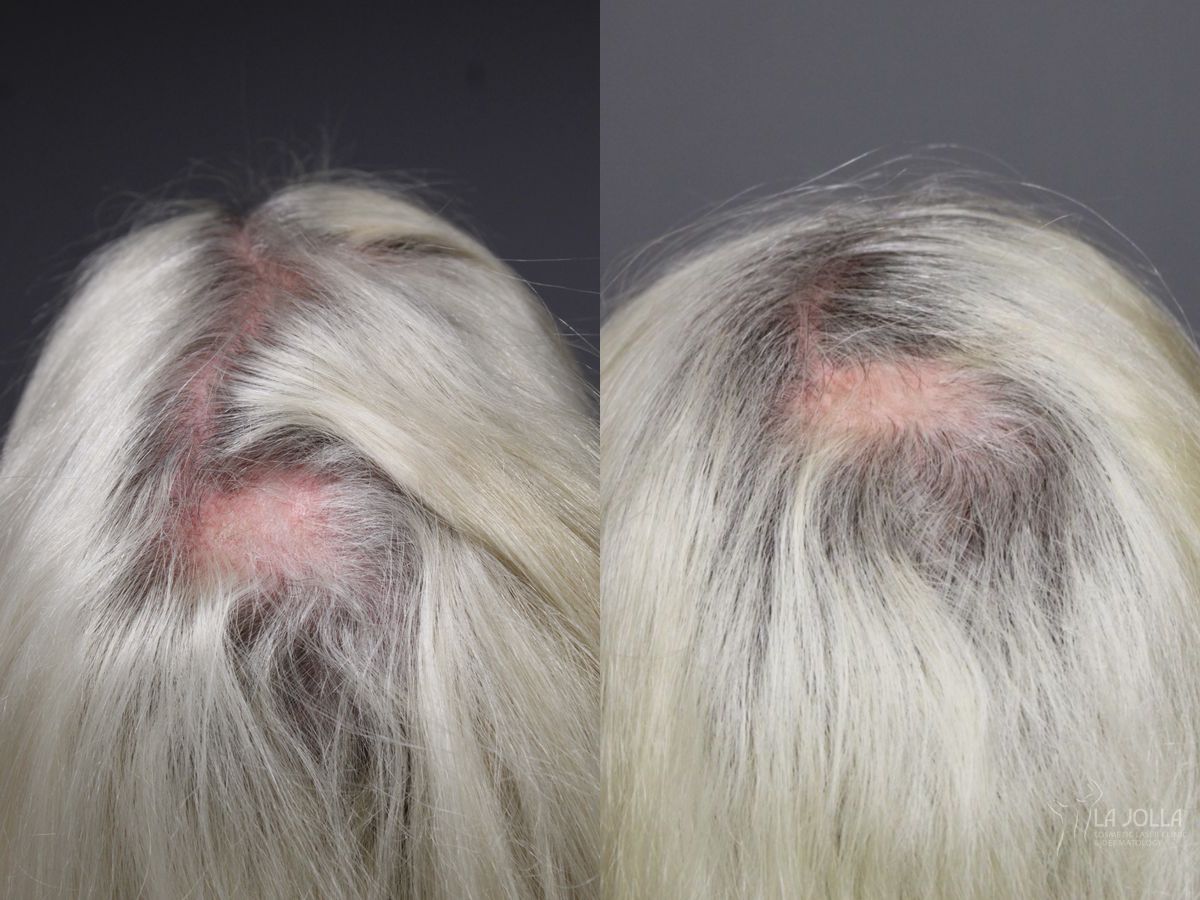 Before and after PRP (Platelet-Rich Plasma) case 43714