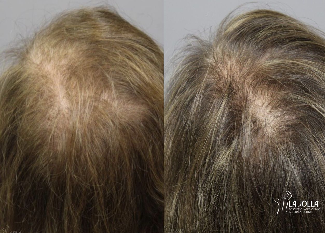 Before and after Laser Hair Growth case 36208