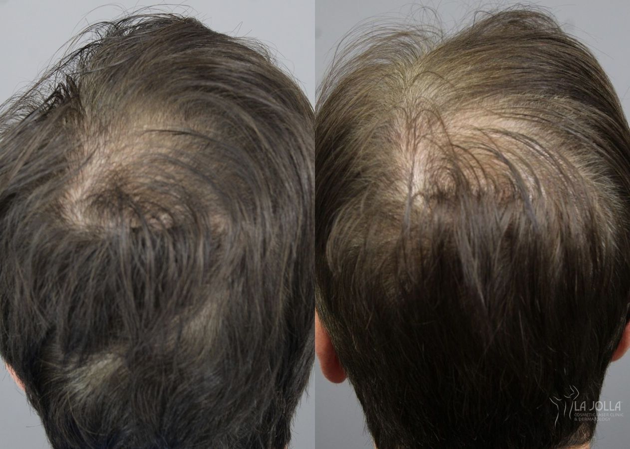 Before and after Laser Hair Growth case 36172