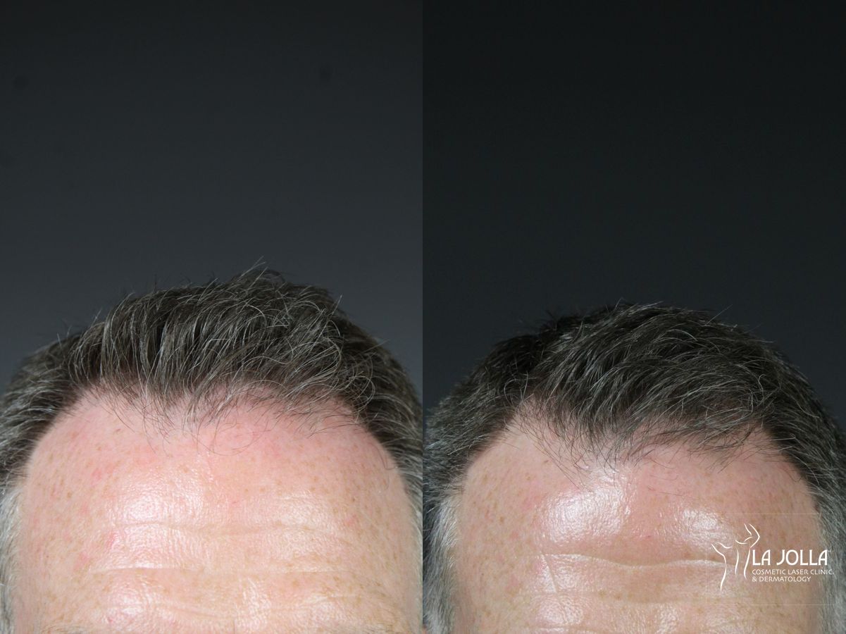 Before and after Laser Hair Growth case 36144 - Angle 5