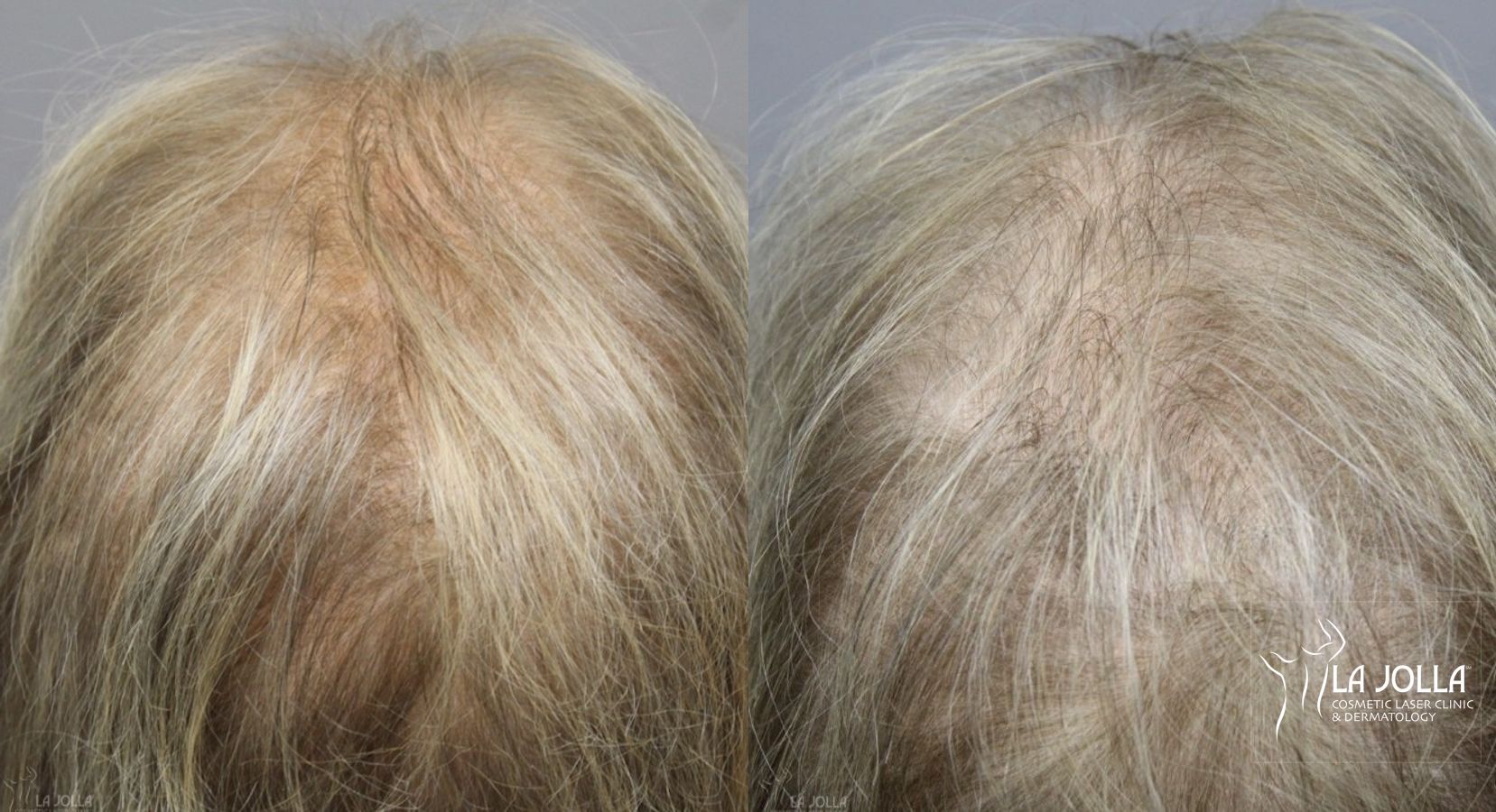 Before and after Laser Hair Growth case 36155