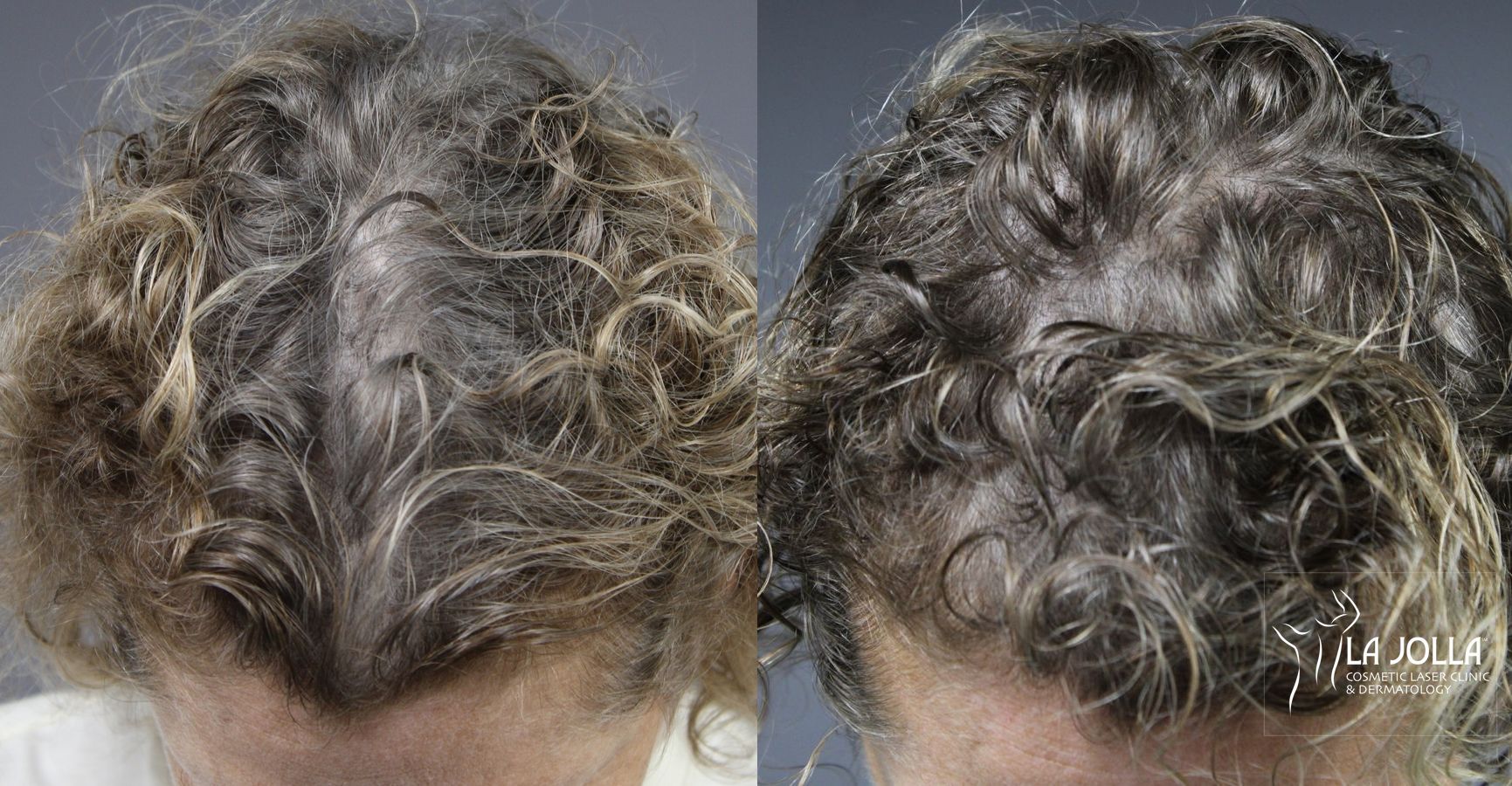 Before and after Laser Hair Growth case 36113