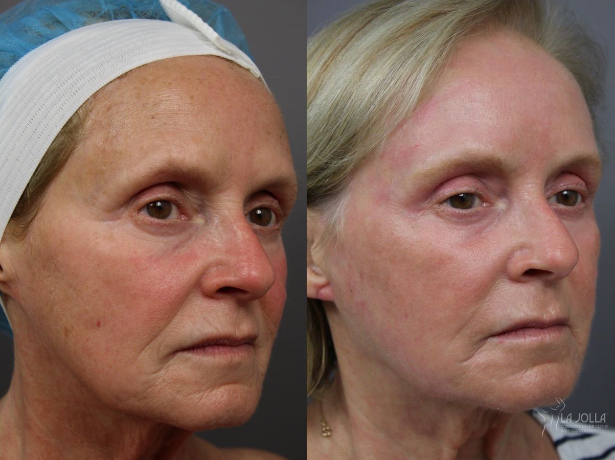 Before and after Laser Skin Resurfacing case 36395 - Angle 2