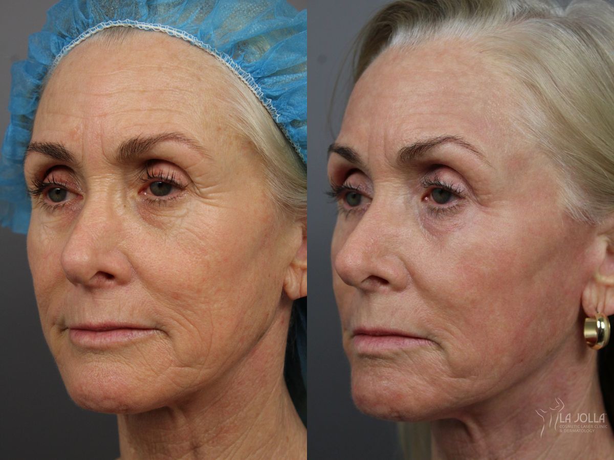 Before and after Laser Skin Resurfacing case 36399 - Angle 3