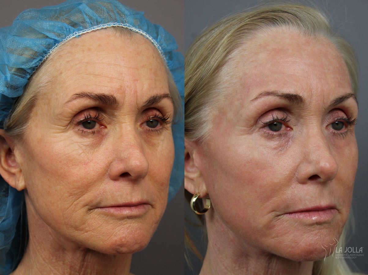 Before and after Laser Skin Resurfacing case 36399 - Angle 2