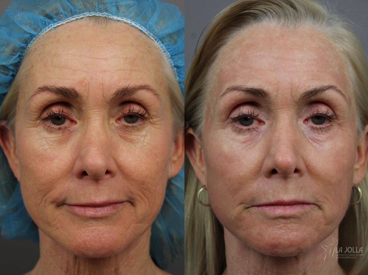 Before and after Laser Skin Resurfacing case 36399