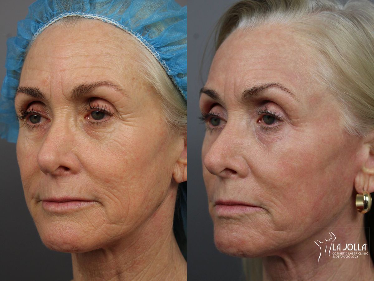 Before and after Laser Skin Resurfacing case 36399 - Angle 3