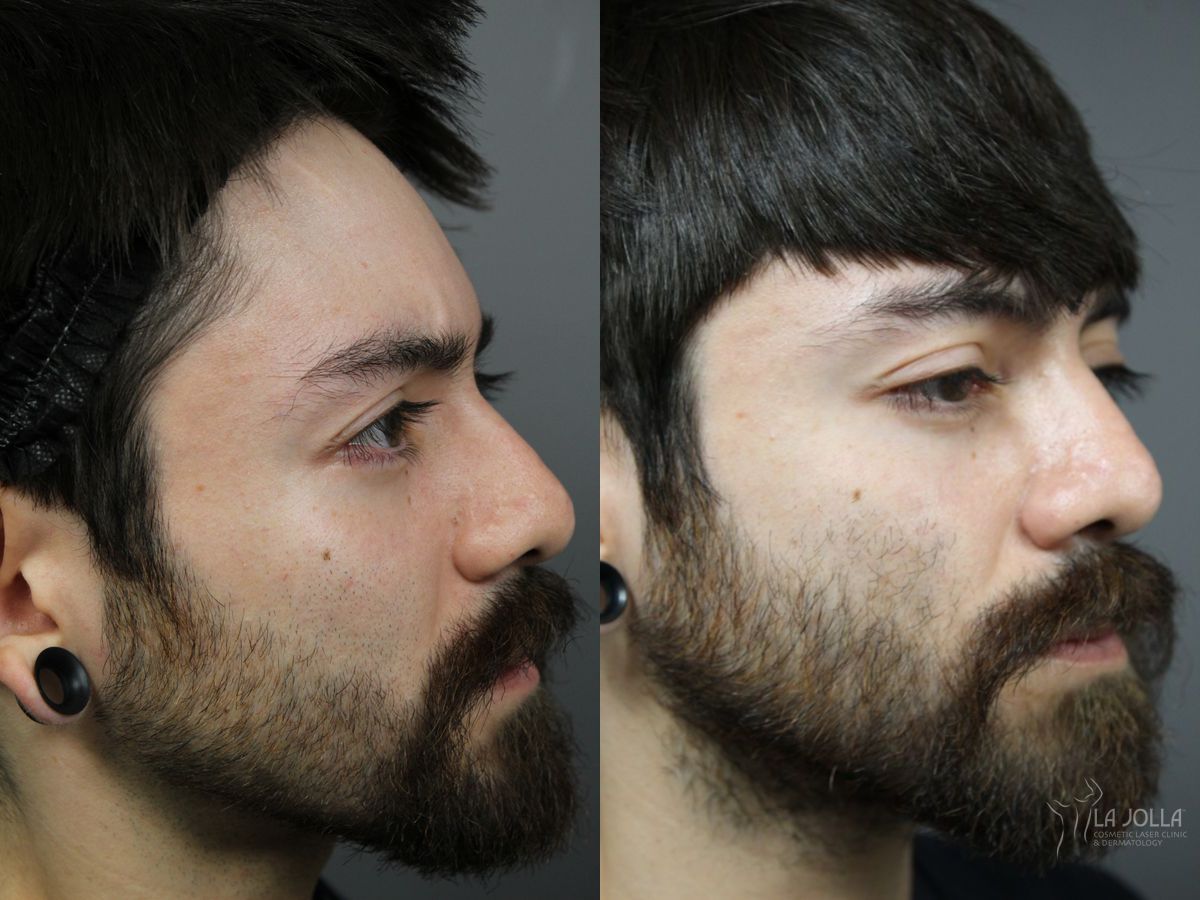 Before and after Laser for Rhinophyma case 36081 - Angle 3