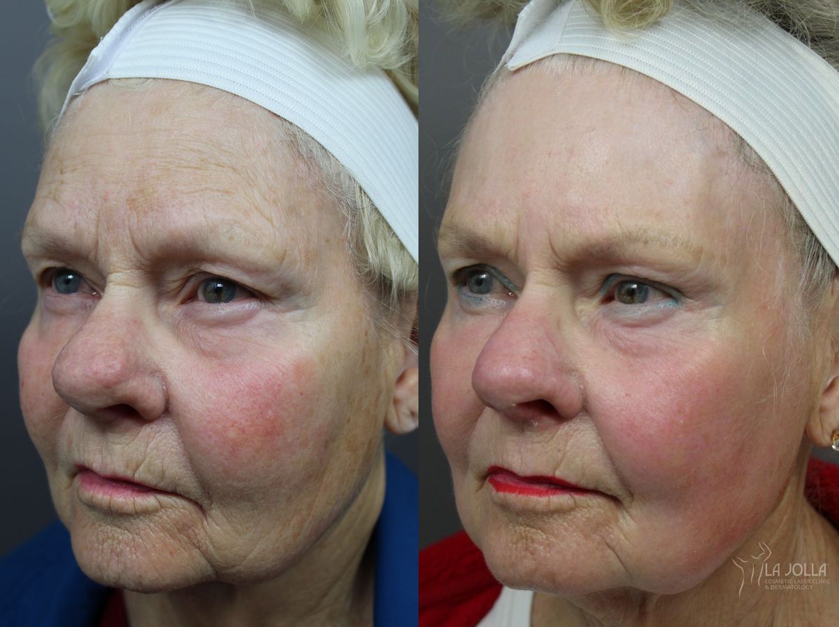 Before and after Laser for Rhinophyma case 36114 - Angle 2