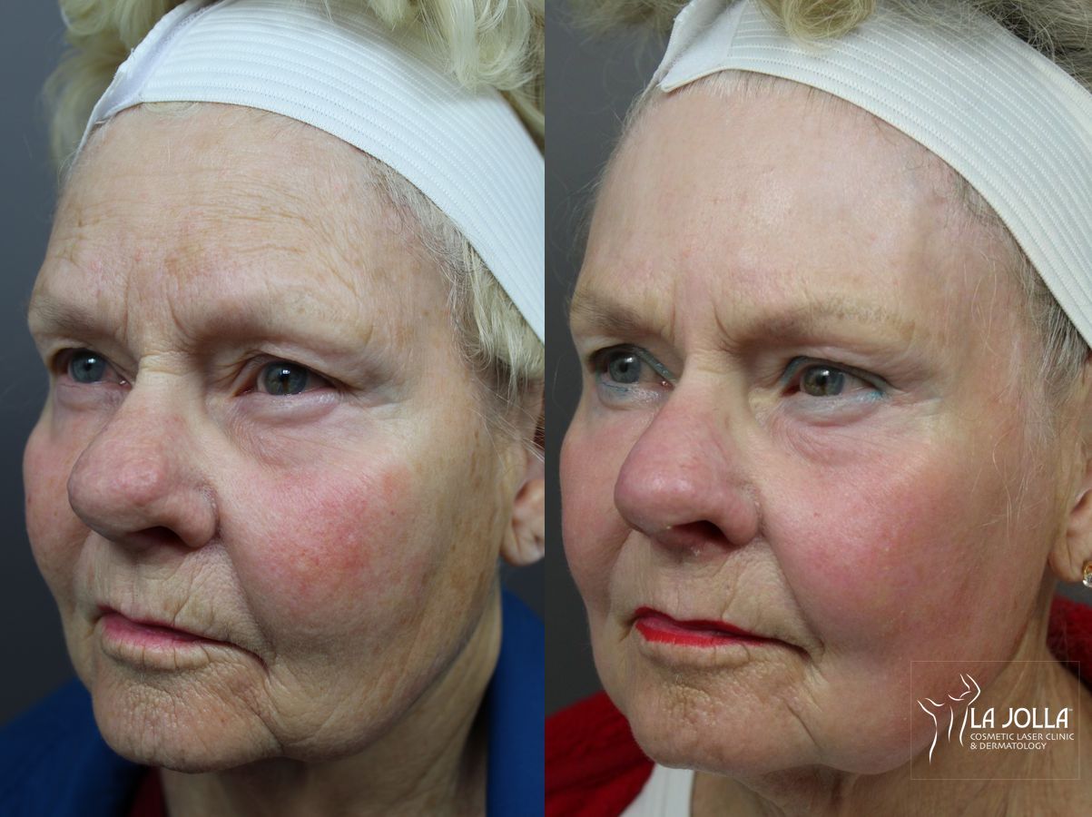 Before and after Laser for Rhinophyma case 36114 - Angle 2