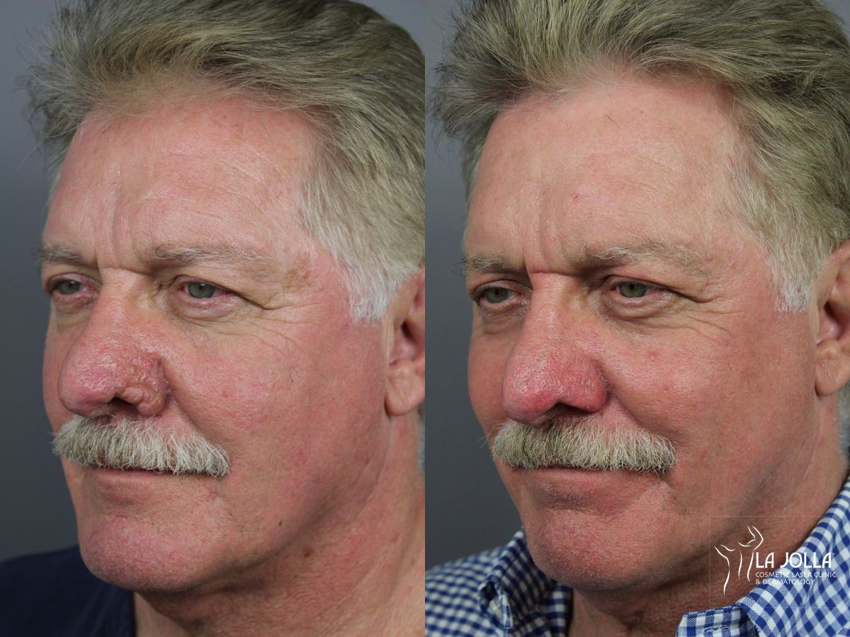 Before and after Laser for Rhinophyma case 36103