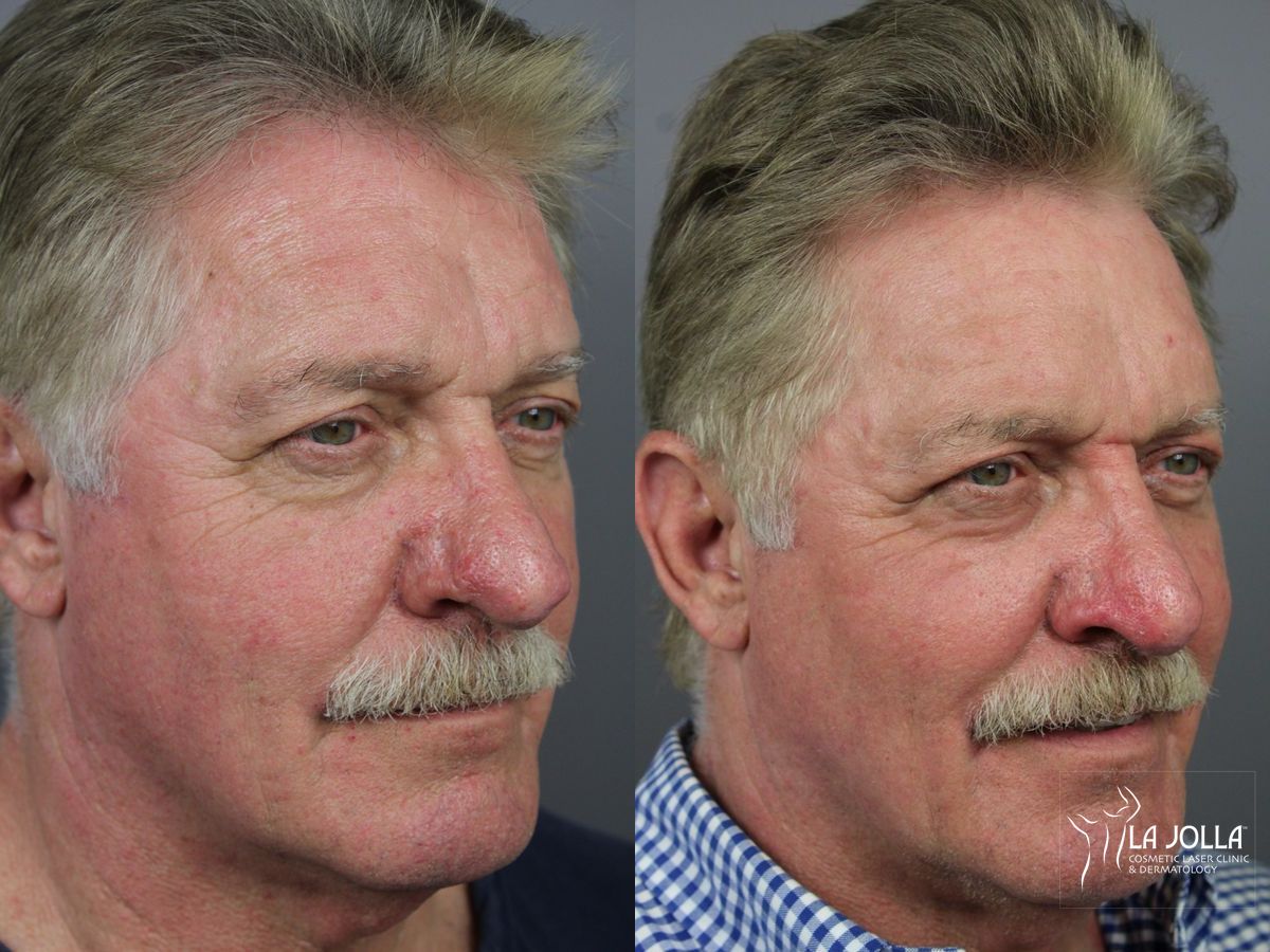 Before and after Laser for Rhinophyma case 36103 - Angle 3