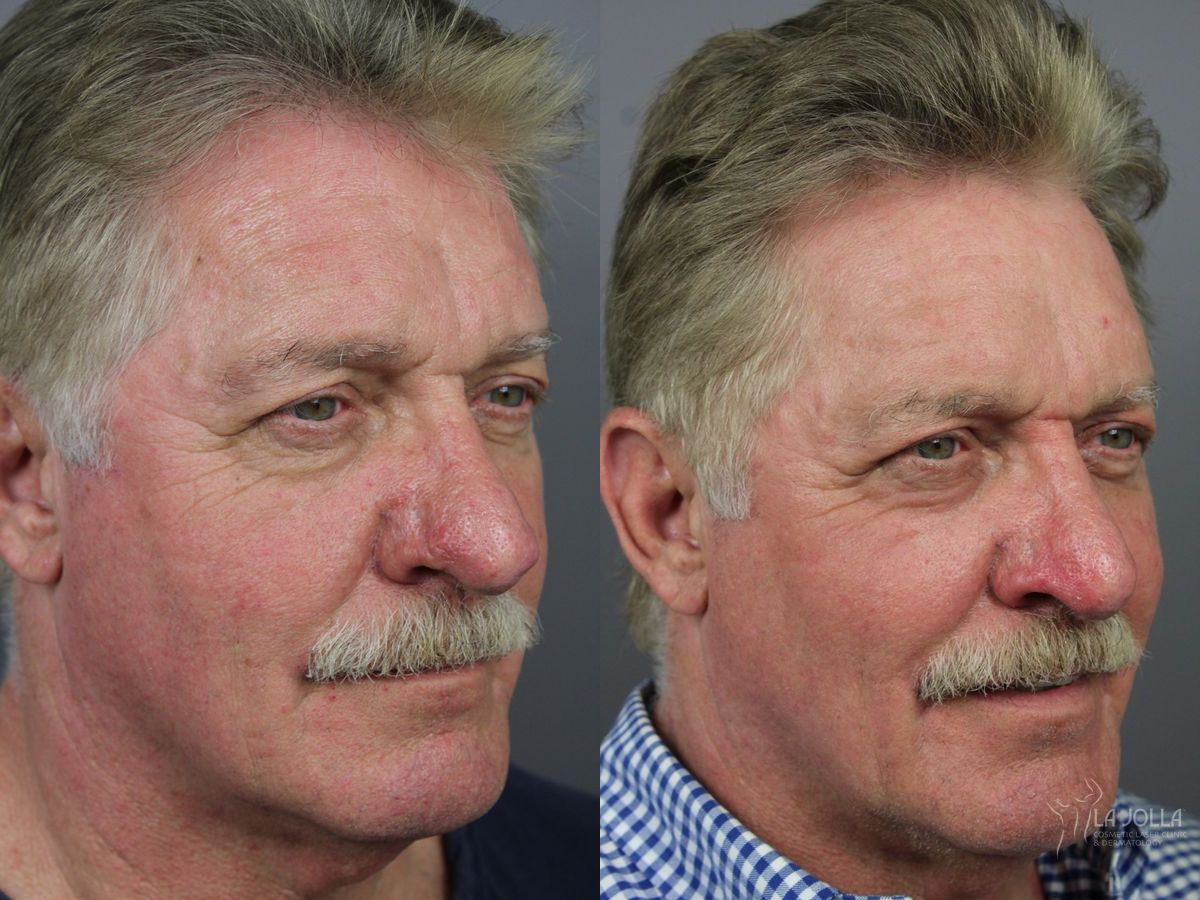 Before and after Laser for Rhinophyma case 36103 - Angle 3