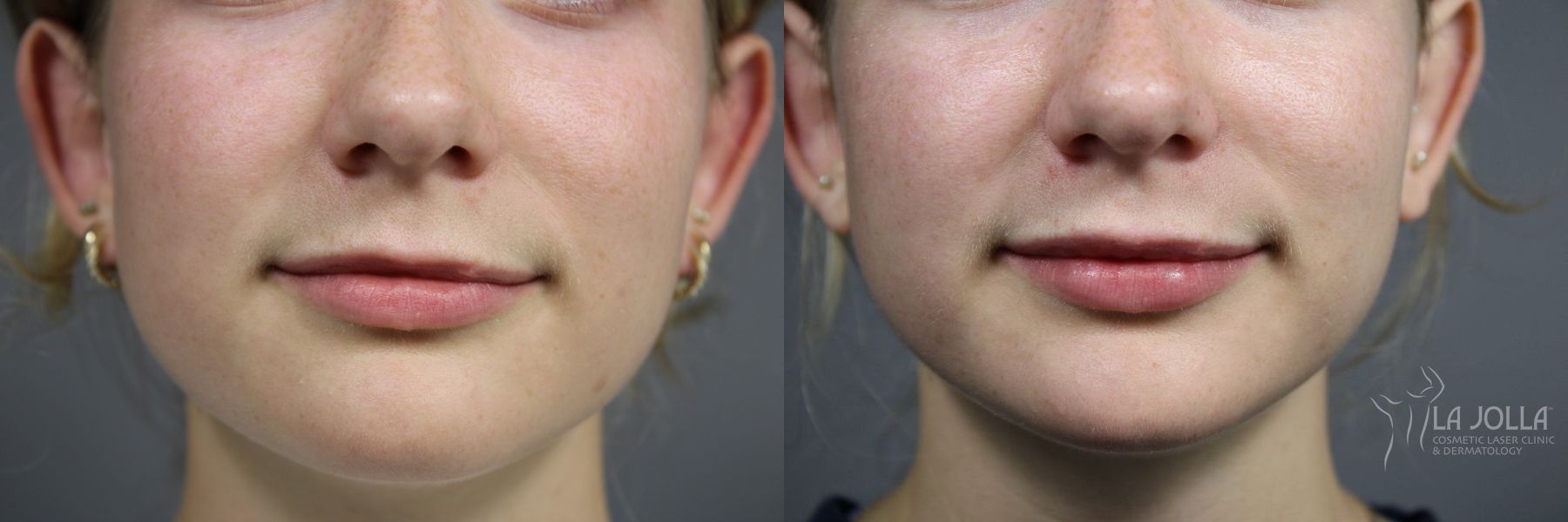 Before and after Lip Filler case 36098 - Angle 2