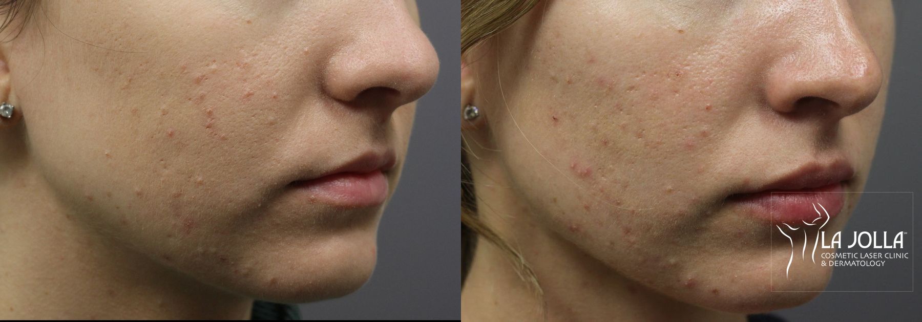 Before and after Lip Filler case 36317 - Angle 2